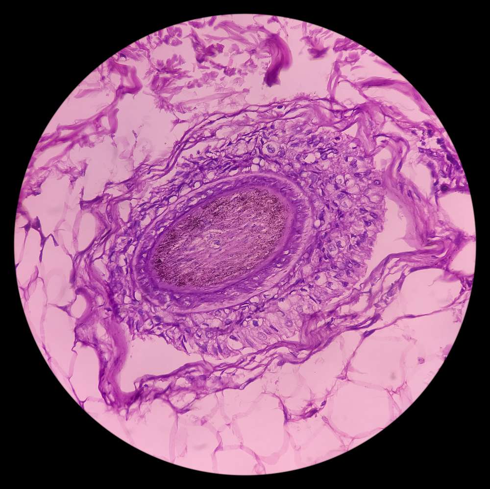 Biópsia de um carcinoma basocelular