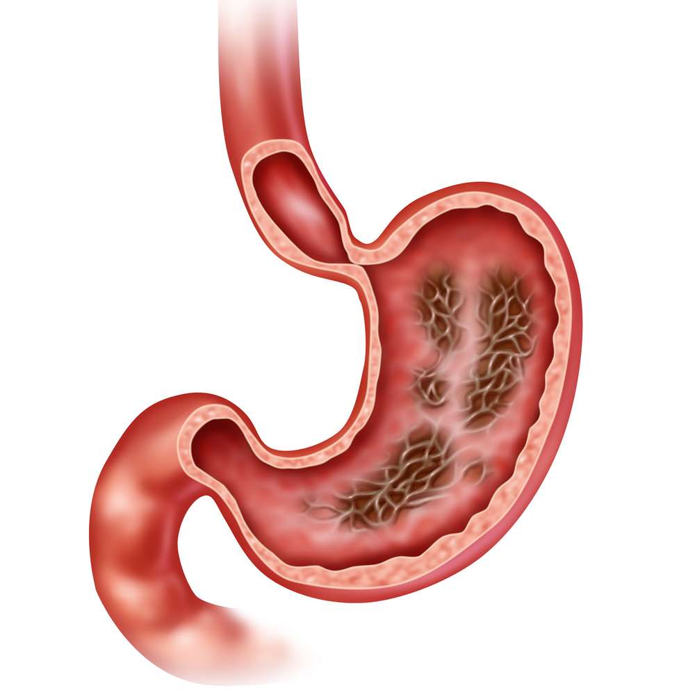 Gastrite doença gastrointestinal Ilustração do estômago com gastrite