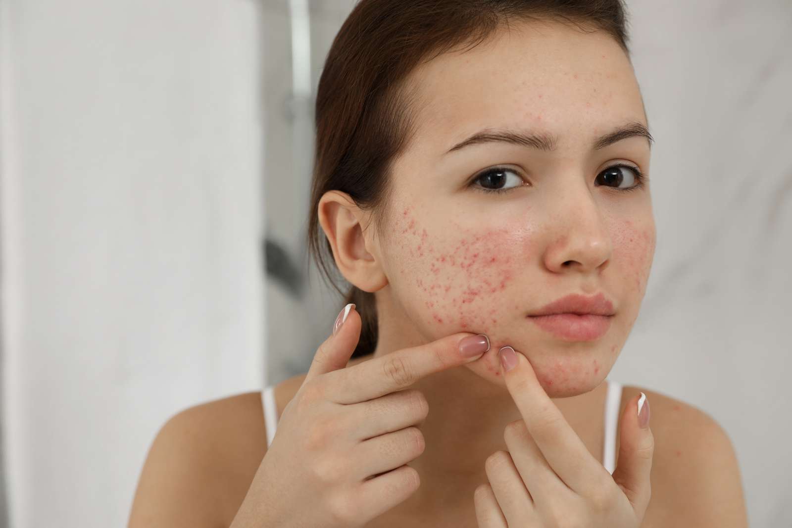 Een vrouw knijpt een puistje uit Tienermeisje met acne probleem knijpt puistje naar binnen
