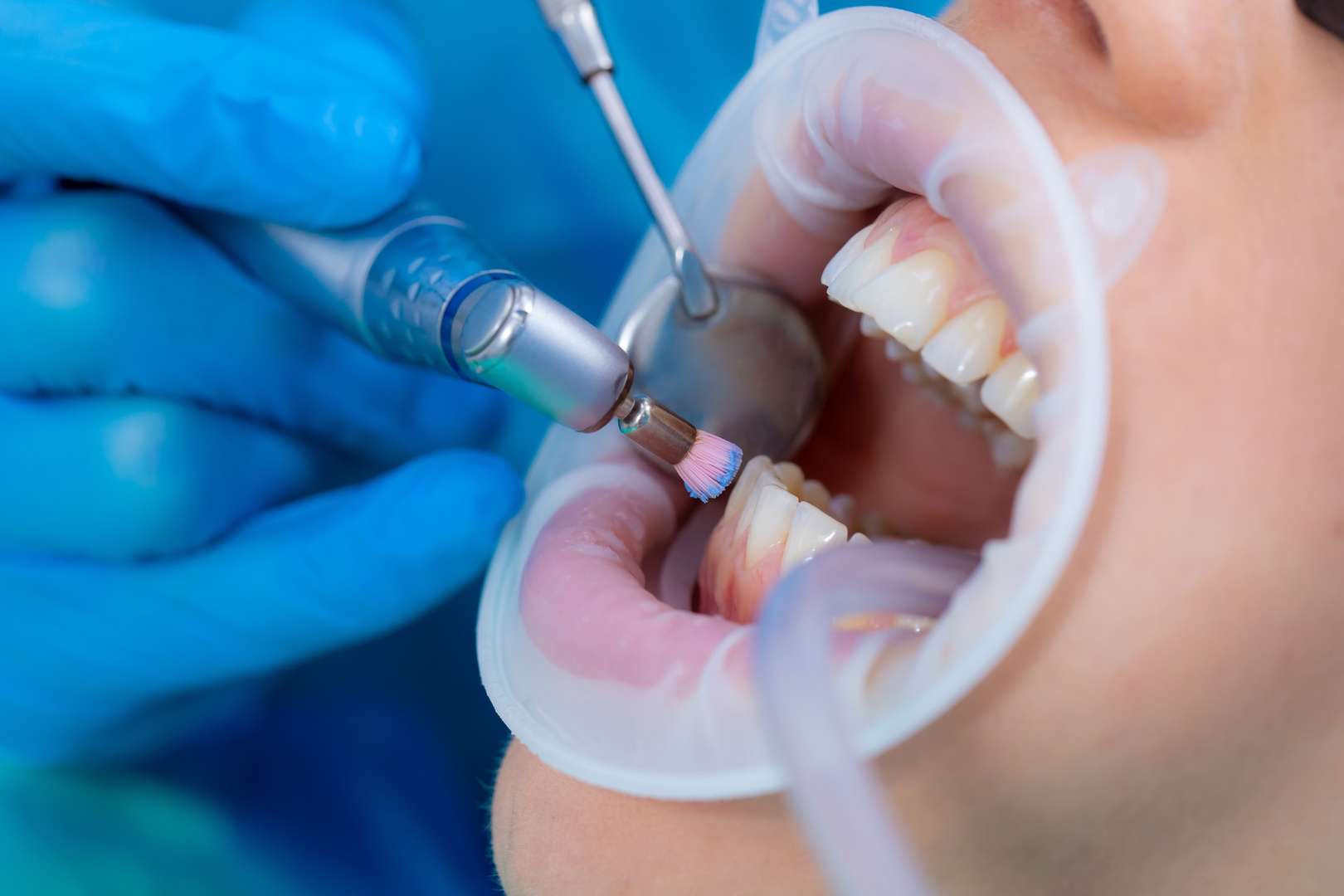 Close-up van een tandboor met een kop voor het polijsten en poetsen van tanden. Professionele mondhygiëne Close-up van een gebitsreiniging