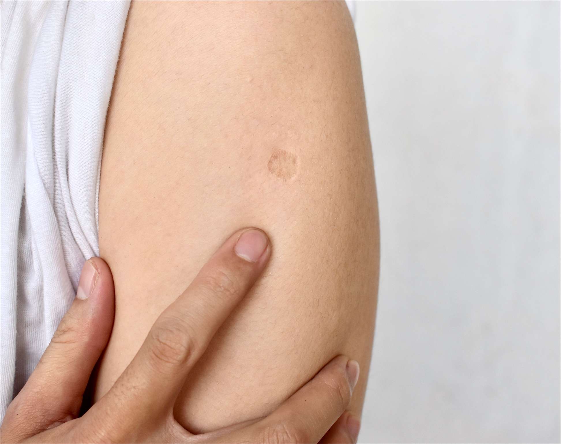 BCG- oder TB-Impfstoffnarbe am Arm eines asiatischen Mannes. Narbe nach BCG-Impfung