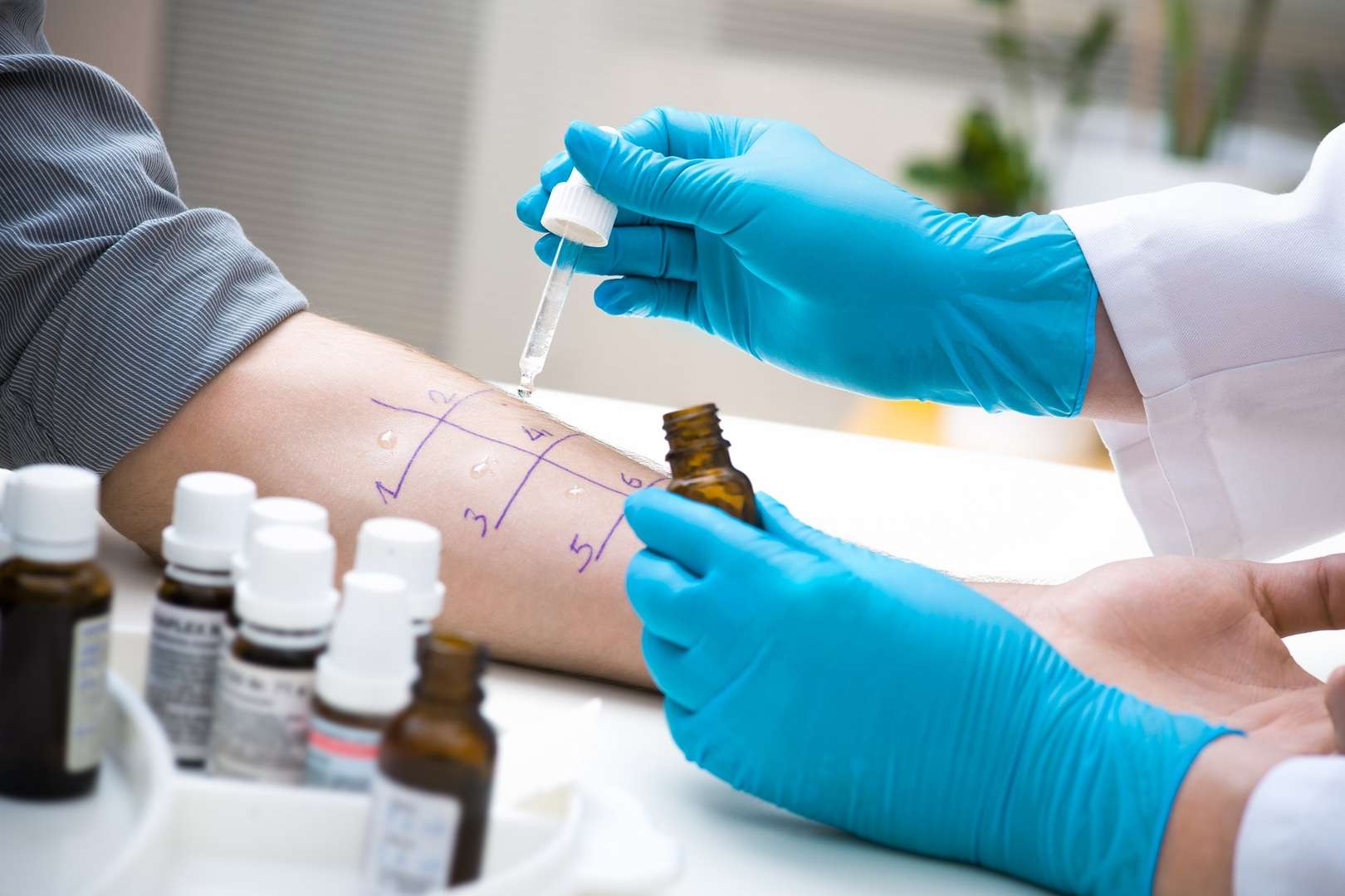 Allergietest wordt uitgevoerd door een specialist.