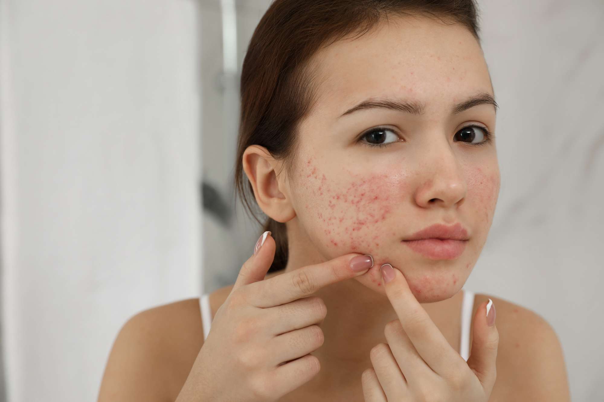 Een vrouw knijpt een puistje uit. Tienermeisje met acne probleem knijpt puistje naar binnen