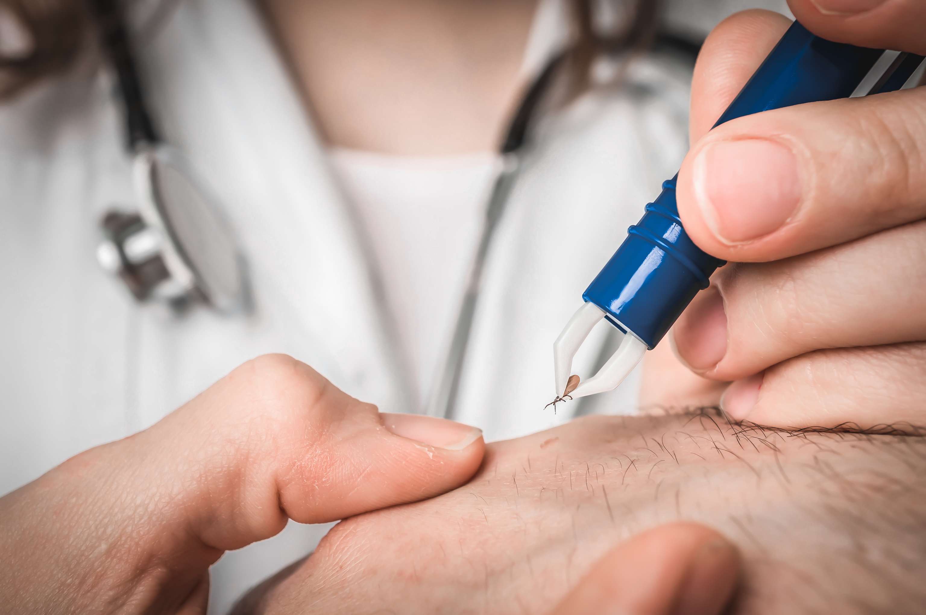 Un médecin enlève une tique avec une pince à épiler