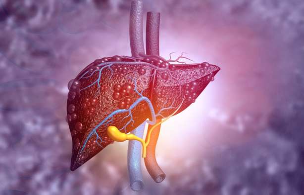 Liver cirrhosis due to alcohol
