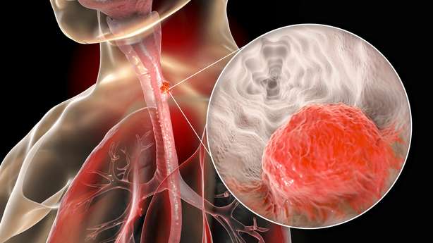 Esophageal cancer, 3D illustration showing malignant tumor in the human esophagus 3D Illustrierung einer Speiseröhre als Röntgen mit einer Detailansicht eines Tumors.