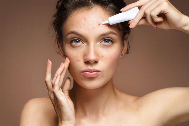 Une adolescente applique une crème de traitement de l'acné sur des boutons. Adolescente avec une peau sans problème appliquant une crème de traitement sur un fond beige. Concept de soins de la peau